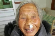 大妈85岁左鼻翼厚硬疼痛1年余左鼻腔棉球涂抹小白瓶
